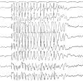 EEG bei Absence